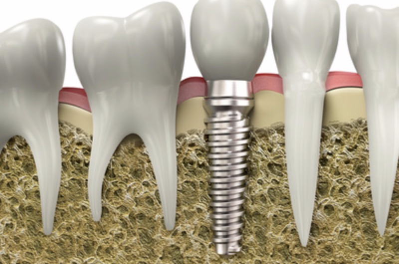 Cosa sono gli Impianti Dentali  e come si inseriscono ?