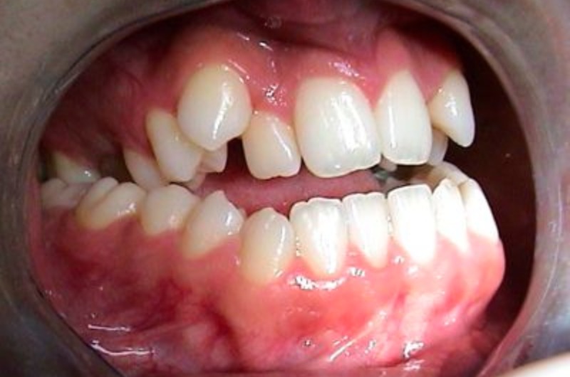 Principali Difetti Ortodontici